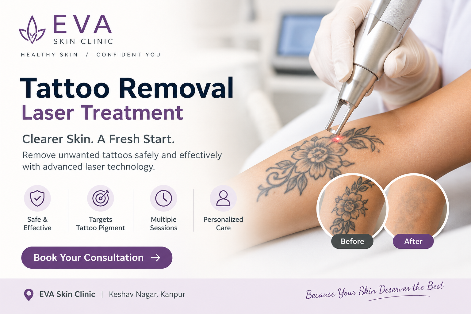 Laser Tattoo Removal Treatment: Process, Benefits, Risks & Aftercare