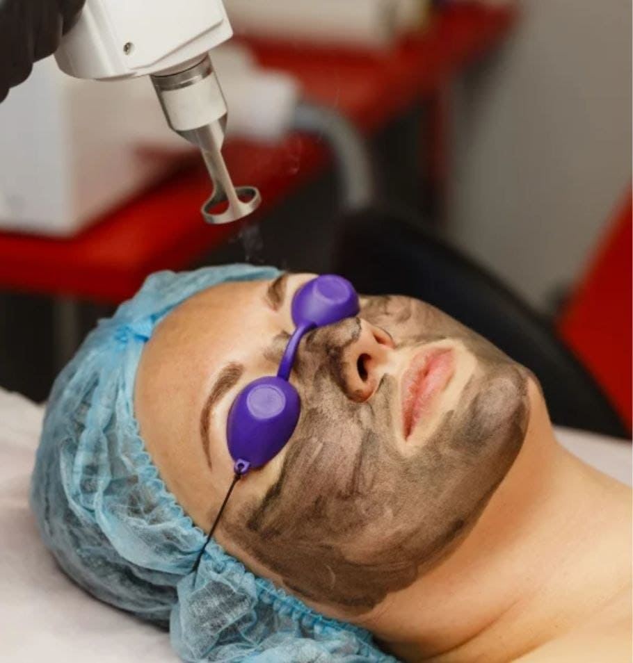 Carbon Laser Facial